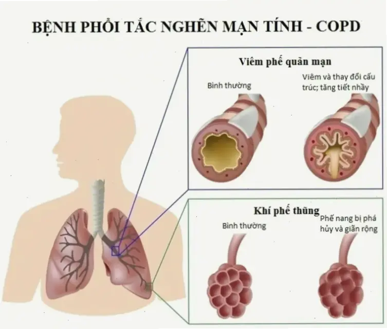 Nguyên nhân và tác động của bệnh