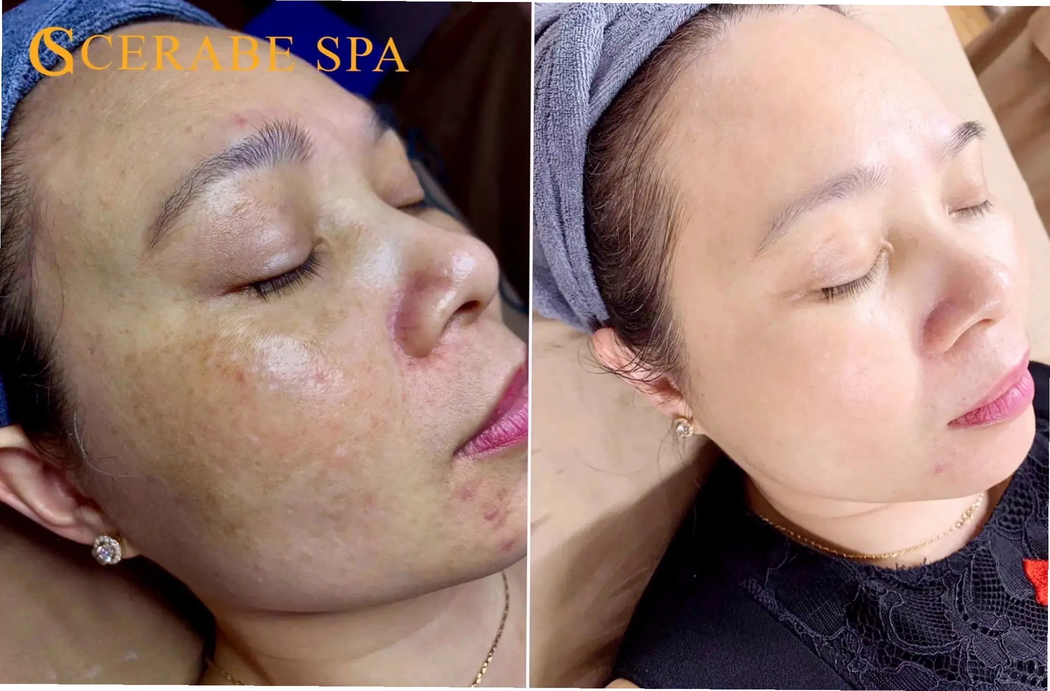 Nguyên nhân da nám mãn tính