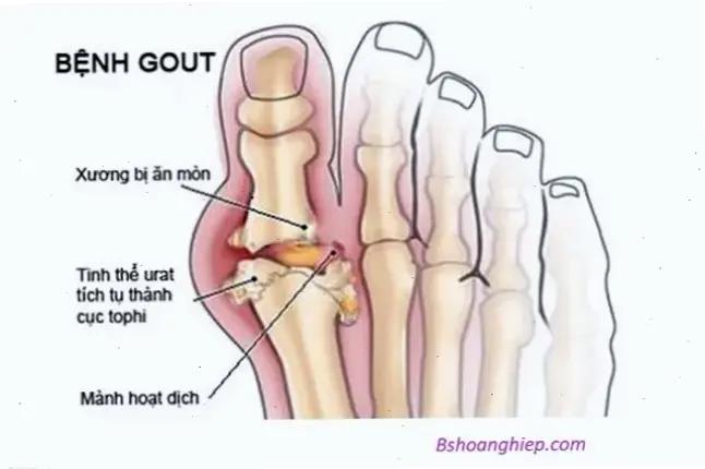 Nguyên nhân và tác động của bệnh