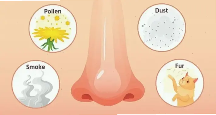 Nguyên nhân và tác động của viêm mũi dị ứng mãn tính