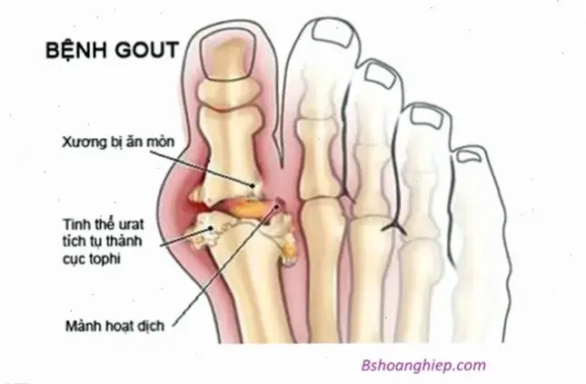 Nguyên nhân và triệu chứng của bệnh gout