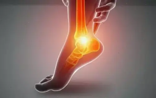 Nguyên nhân và triệu chứng của gout mãn tính nặng