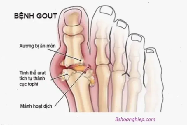 Nguyên nhân và triệu chứng