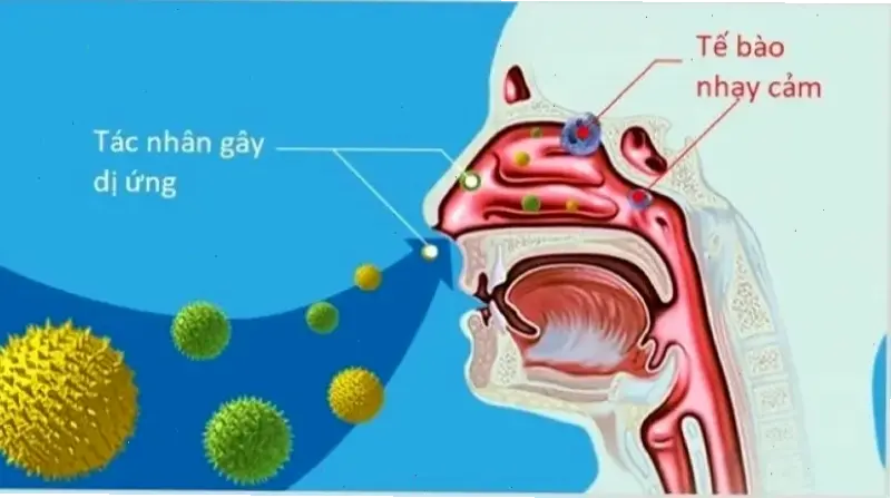 Nguyên nhân và triệu chứng